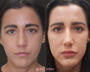 Lip filler before and after showing soft volume enhancement