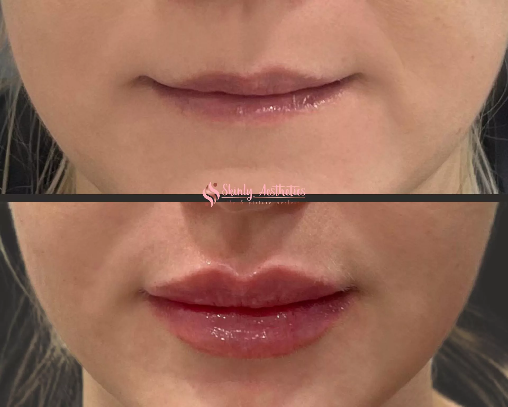 Lip filler before and after improving lip symmetry and contour
