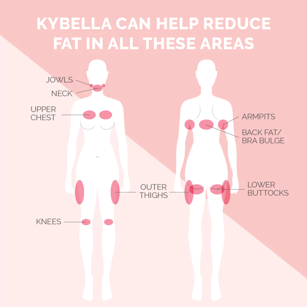 Kybella Treatment Areas Graphic