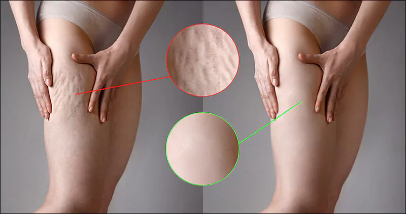 Cellulite is a complex multifactorial process what are the options