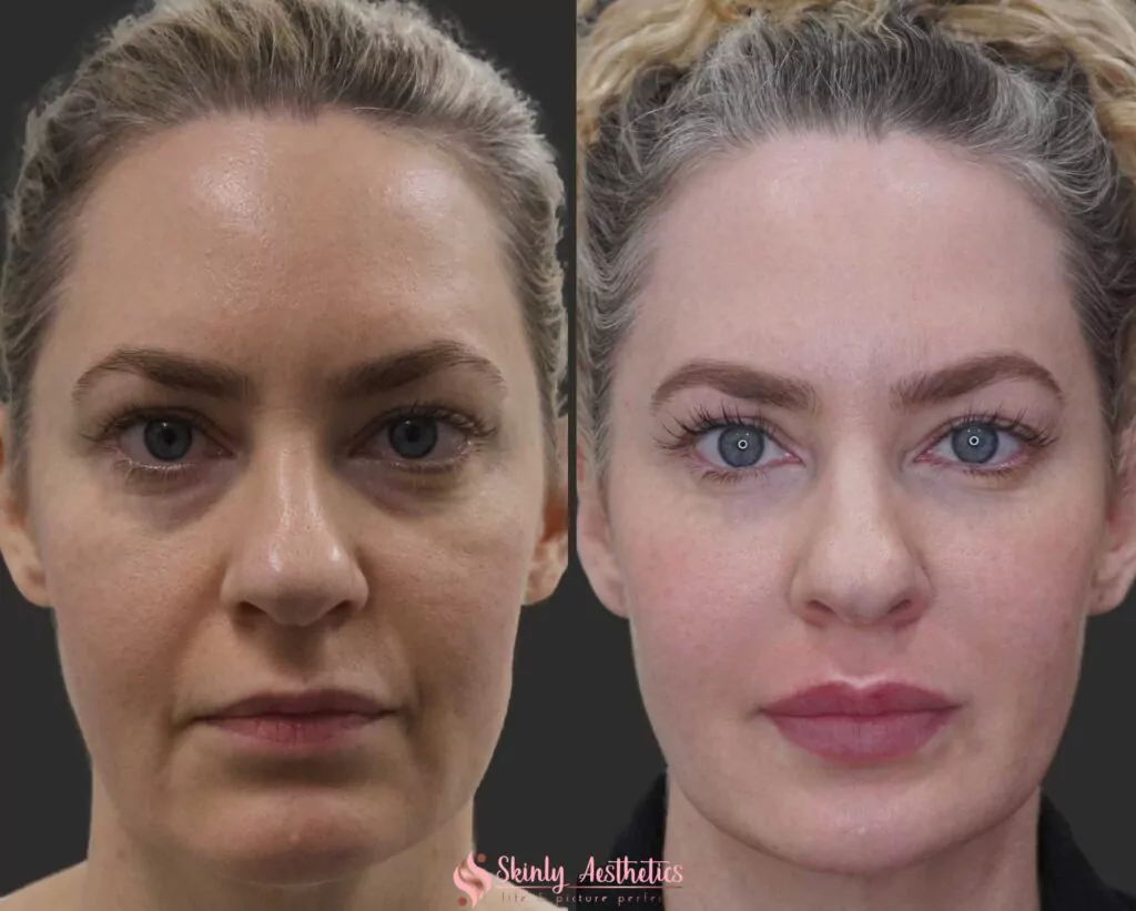 Juvederm dermal filler for under eyes