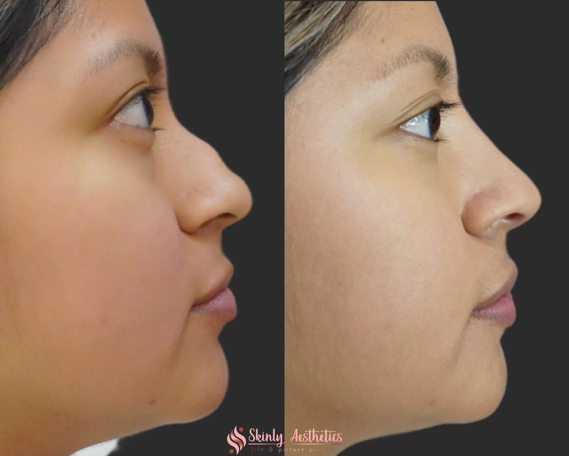Juvederm filler for non surgical nose straightening