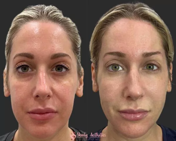 PDO thread lift with barbed sutures to lift droopy cheeks and jowls