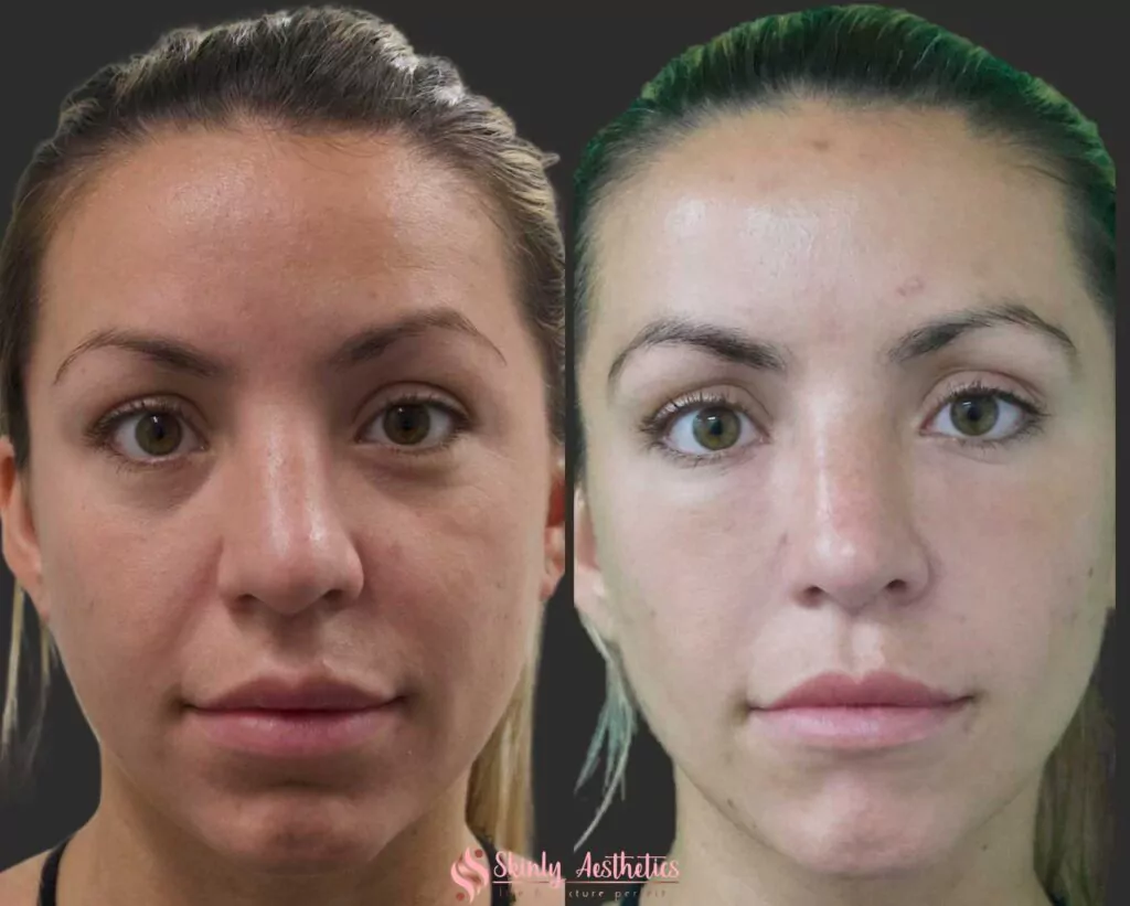 Restylane dermal filler for under eyes