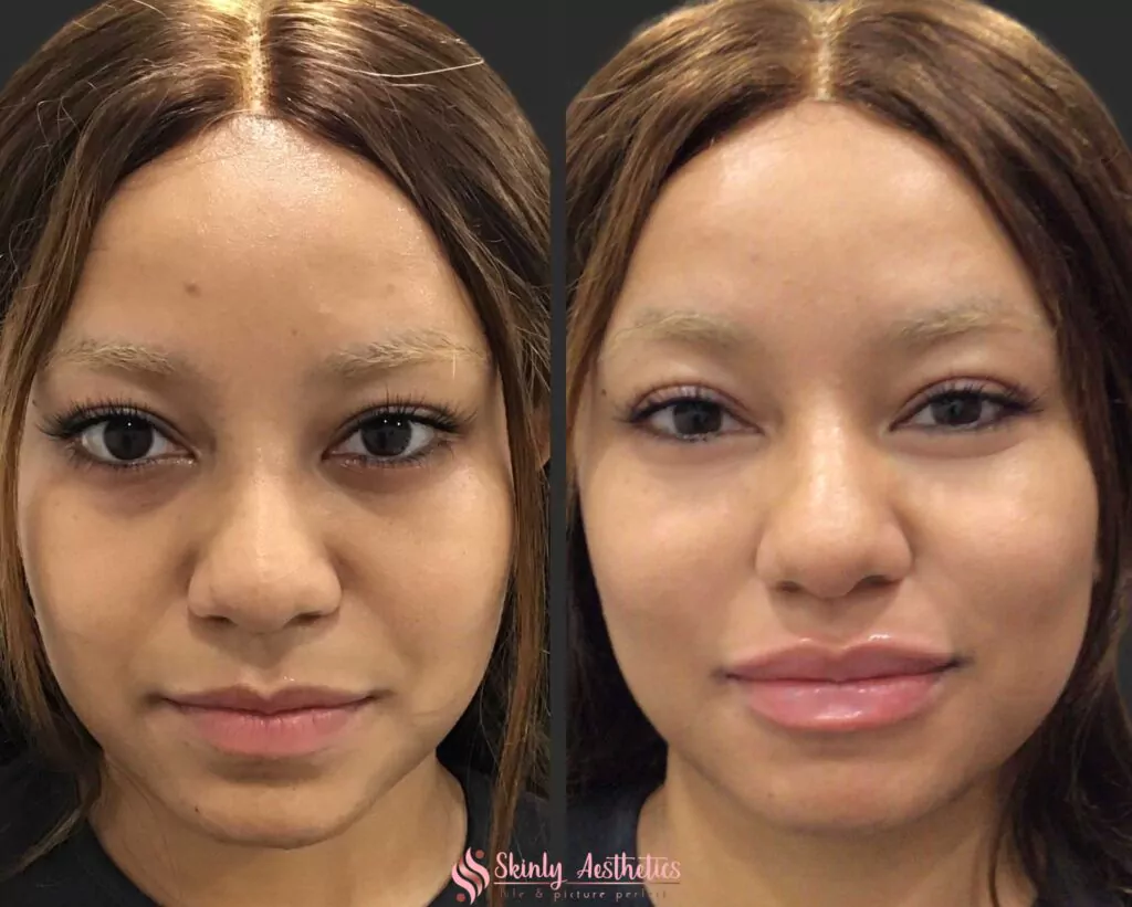 Russian style lip filler injection