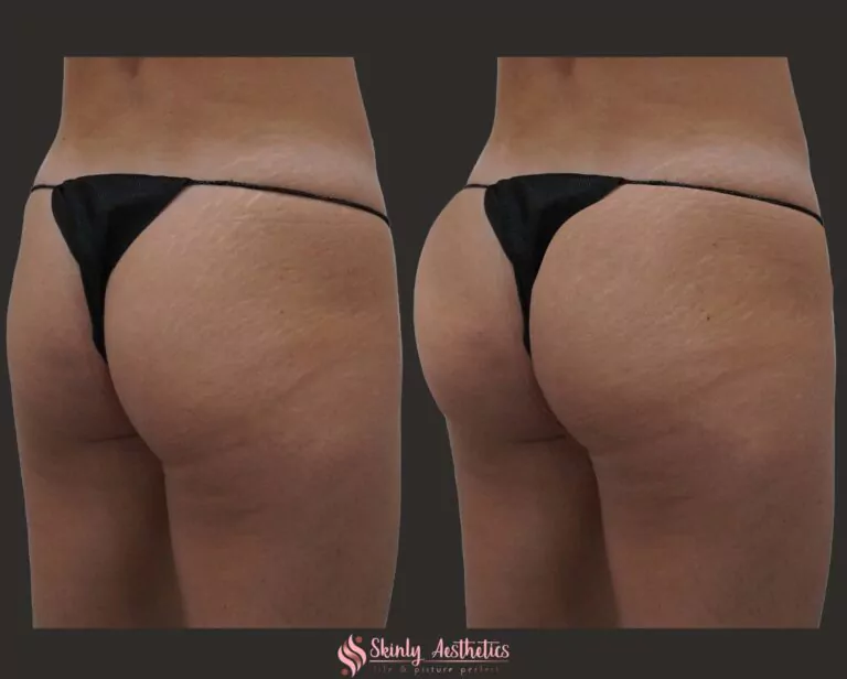 Sculptra buttocks augmentation
