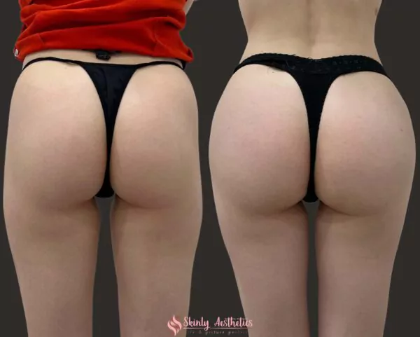 Sculptra filler injections for deep hip dips dents
