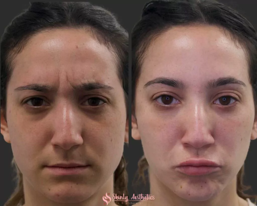 botox 11s wrinkles