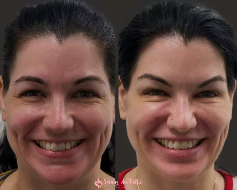 botox crows feet lines reduction