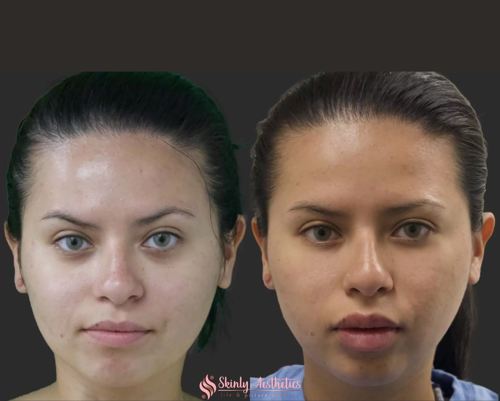 botox non surgical jawline reduction