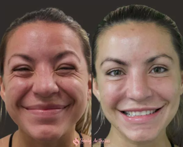 botox procedure crows feet wrinkles