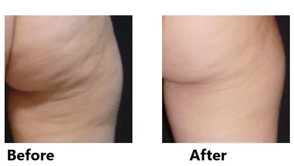 before and after results of acoustic wave therapy for cellulite on bottom