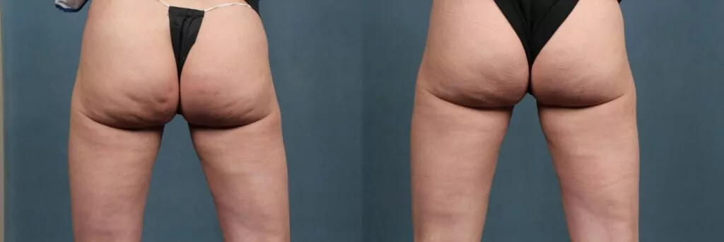 before and after results of Fraxel lasers on butt cellulite