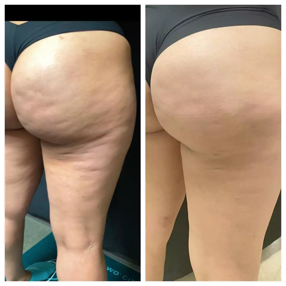 before and after results on buttocks and thighs using QWO treatment