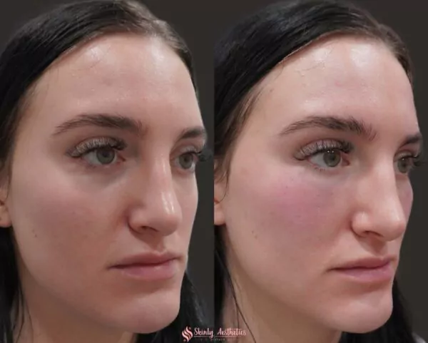 cheek augmentation and under eye bag treatment