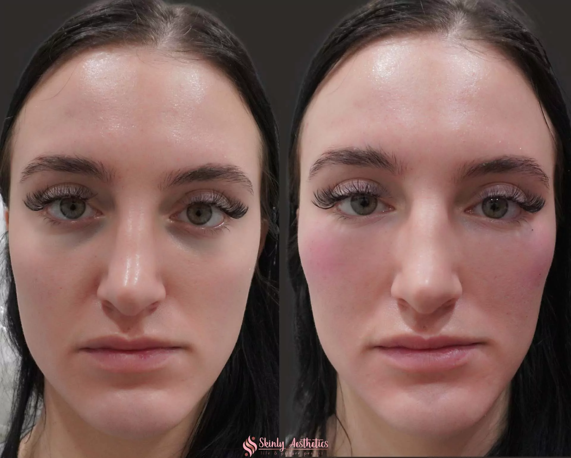 cheek augmentation and under eye dark circles treatment with Juvederm filler 1