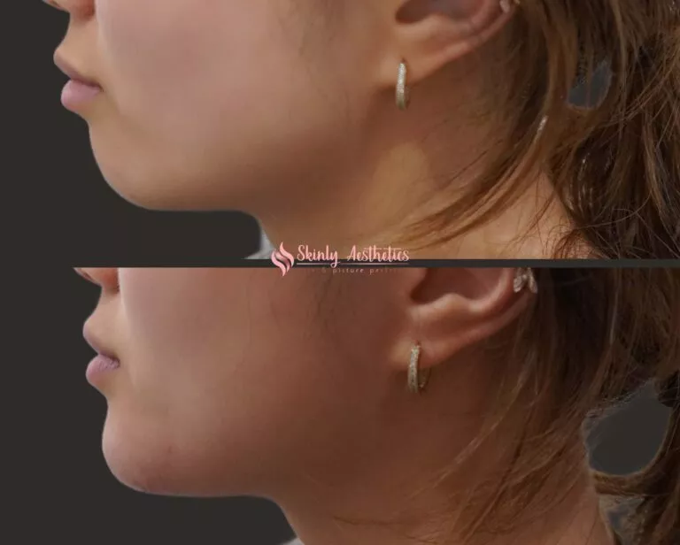 chin elongation and augmentation with Juvederm Voluma filler