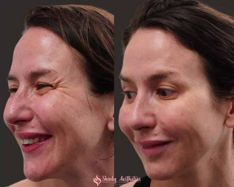 crows feet reduction with botox