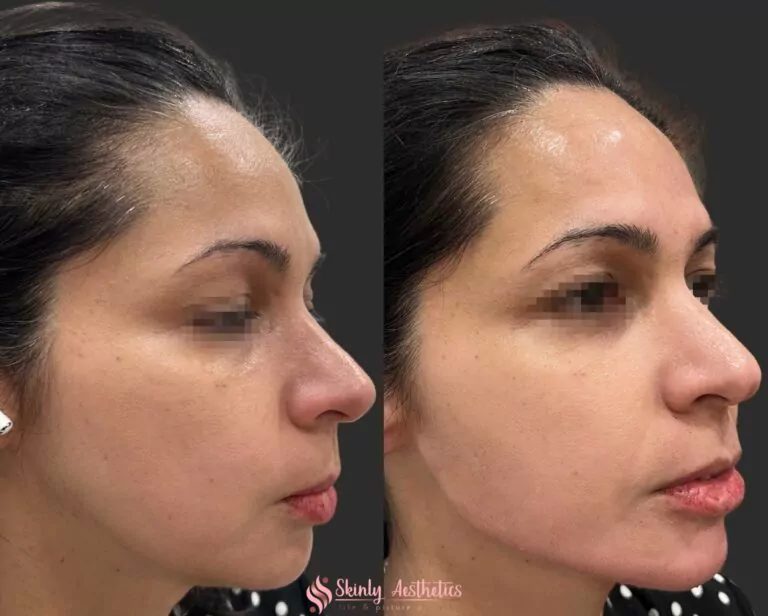 jawline sculpting and definition with Radiesse filler
