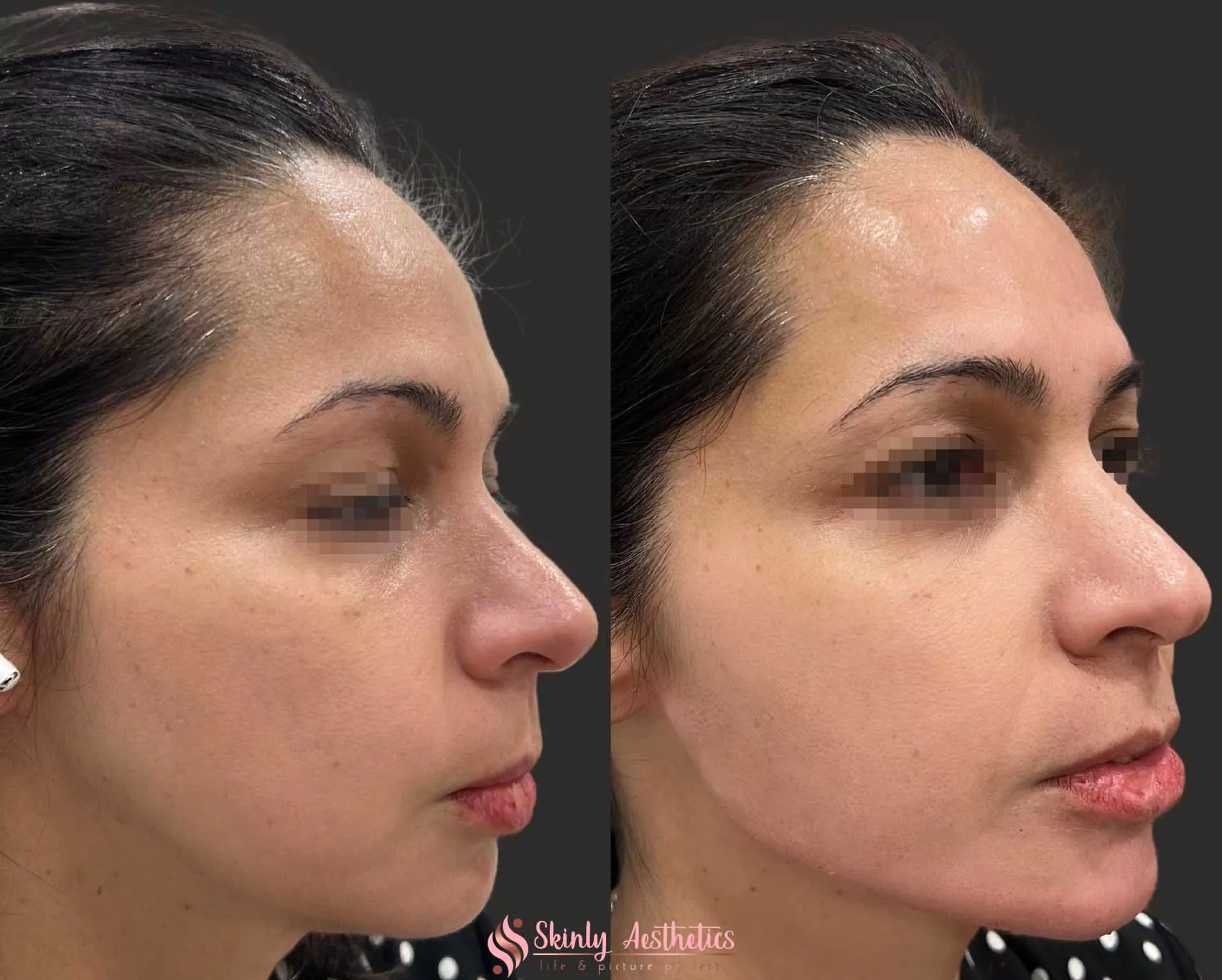 jawline sculpting and definition with Radiesse filler