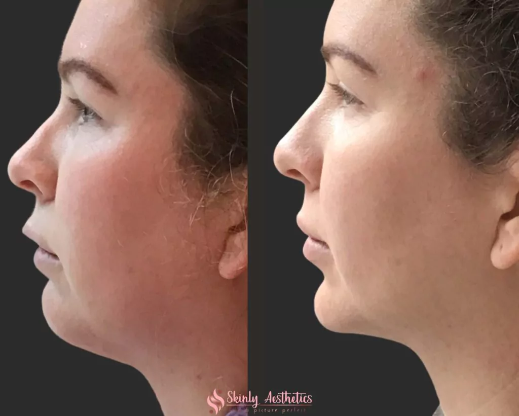 kybella injections for double chin fat removal