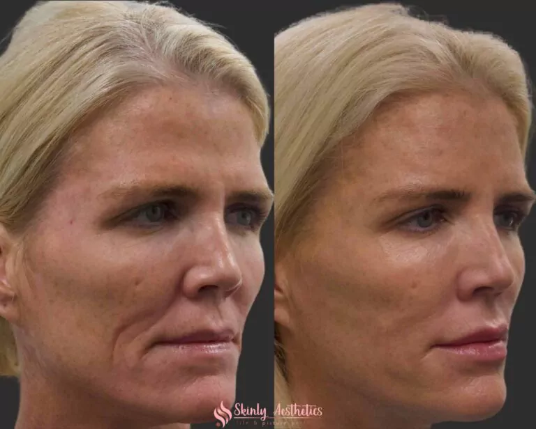 laugh lines and nasolabial fold correction with Juvederm Ultra