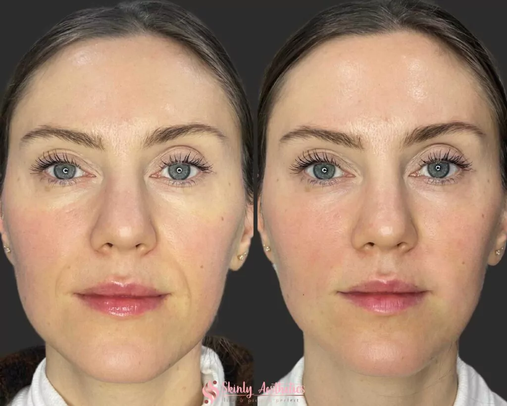 laugh lines smoothing Juvederm Ultra dermal filler