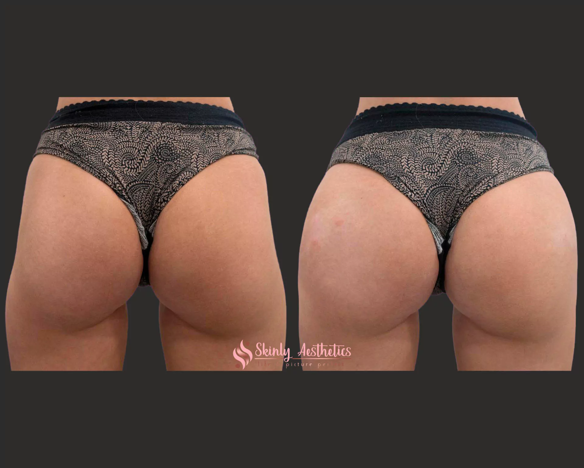 non surgical butt lift with Sculptra