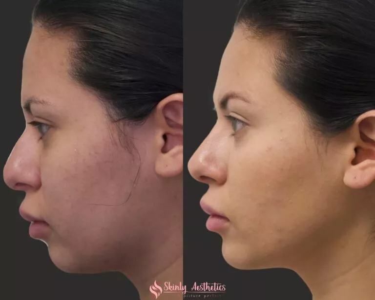non surgical chin and jawline augmentation with Juvederm Voluma