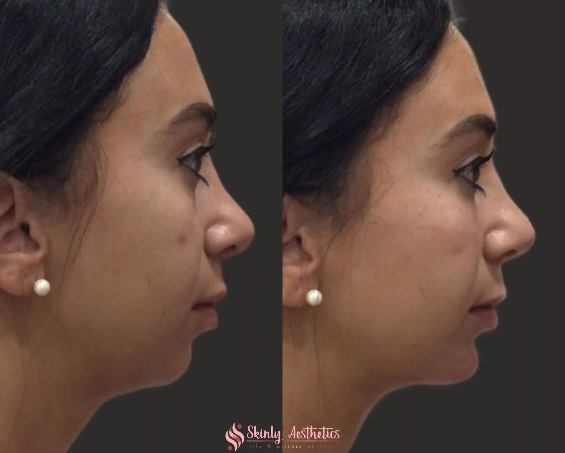 non surgical chin augmentation with Juvederm