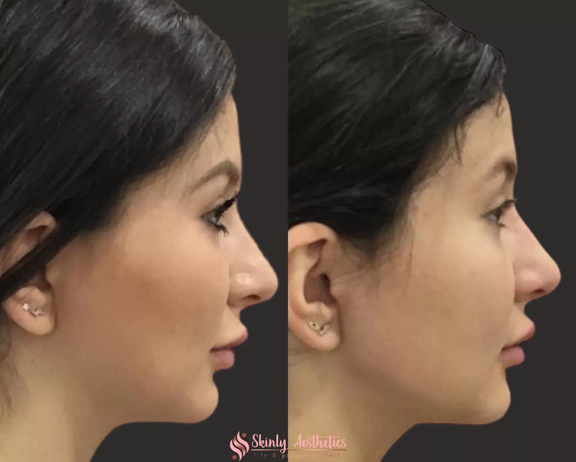 non surgical jawline augmentation