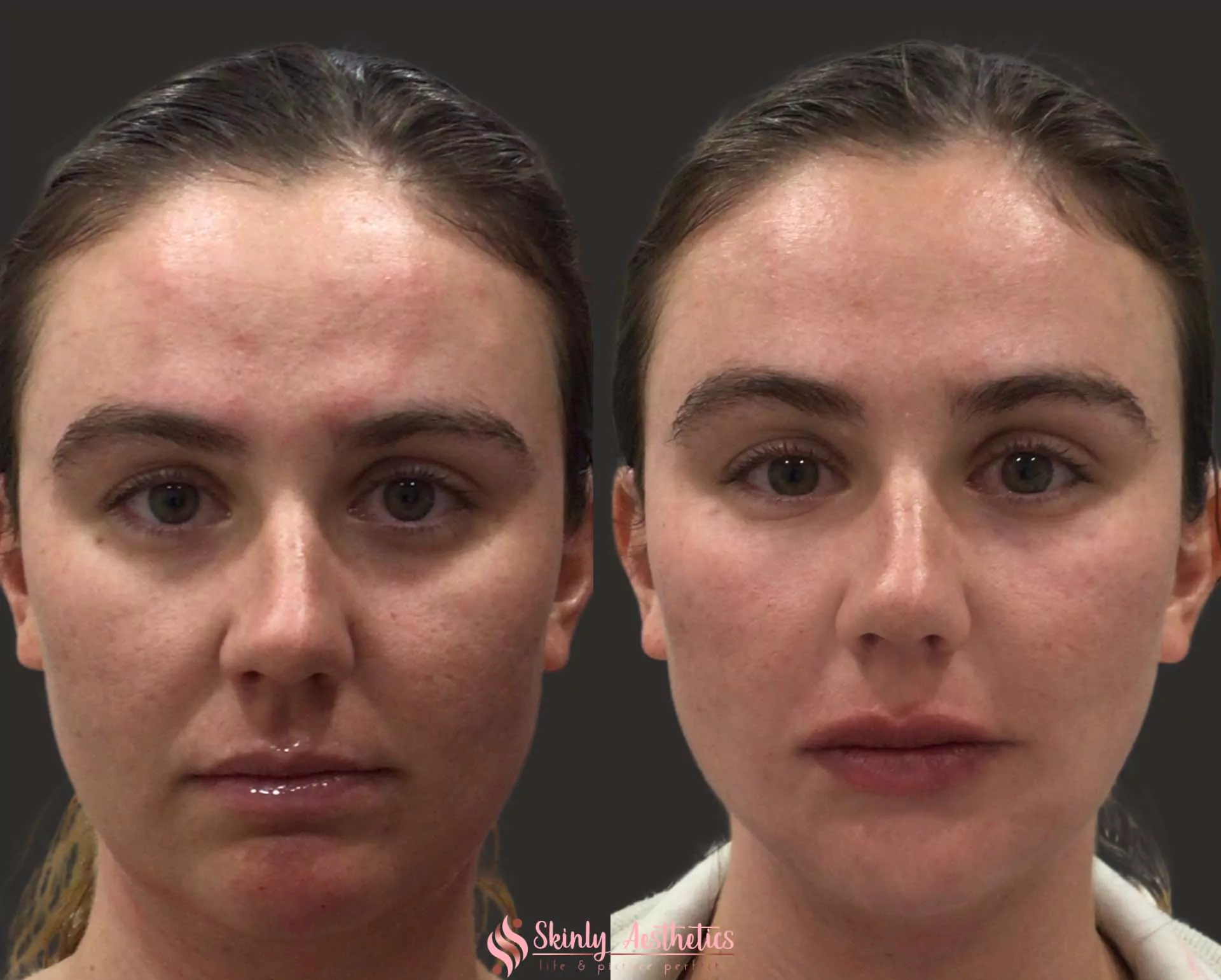 non surgical jawline slimming with botox
