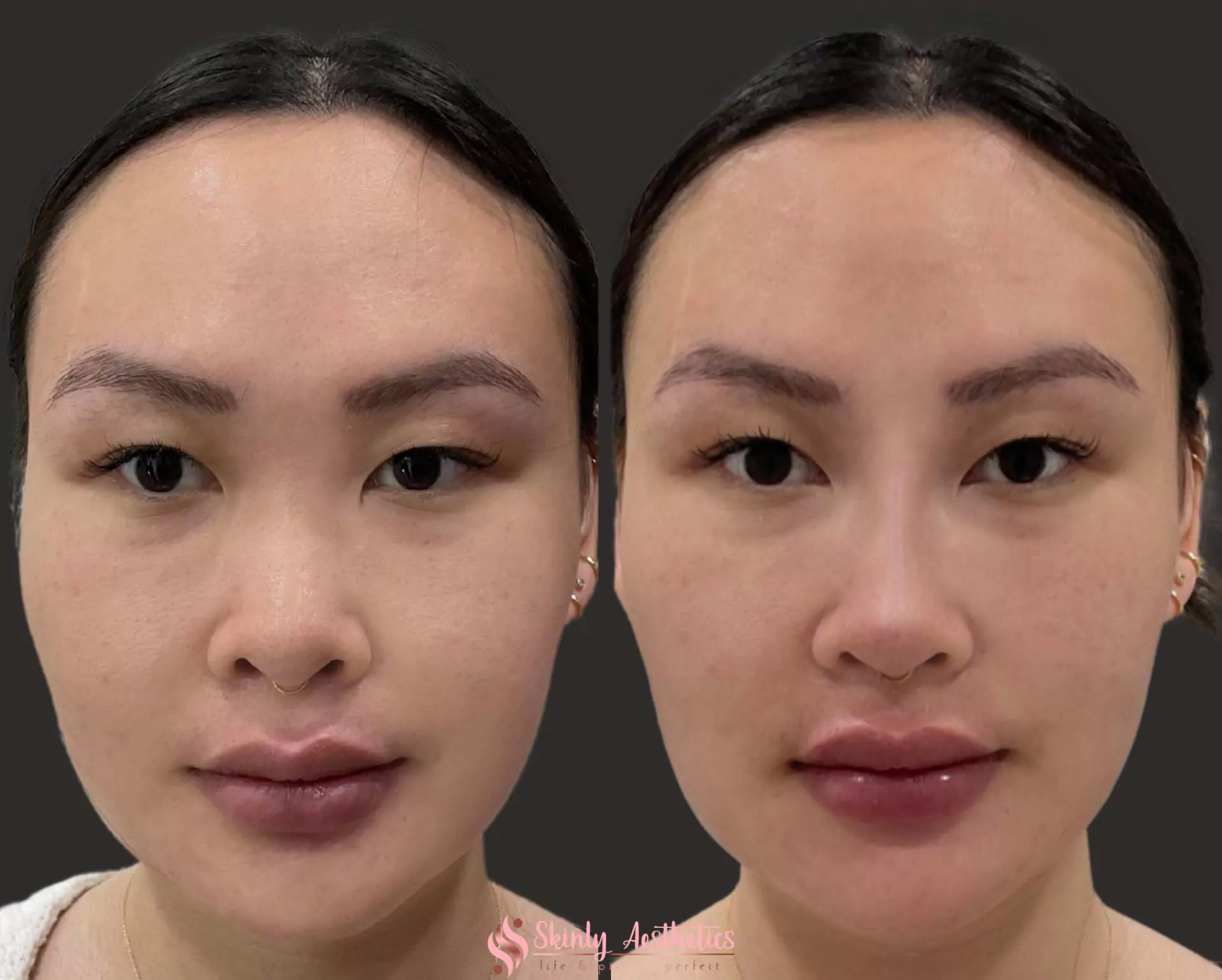 non surgical rhinoplasty to slim the nose and raise the nose bridge
