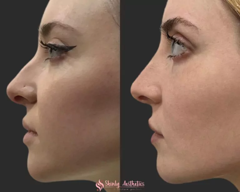 nose contouring with filler and nose tip lifting