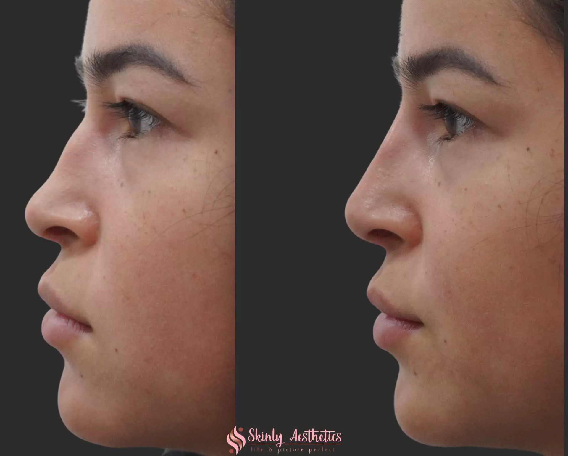 nose slimming filler injections