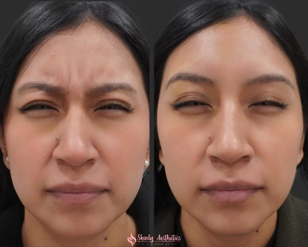resolution of 11s line following administration of 20 units of Botox