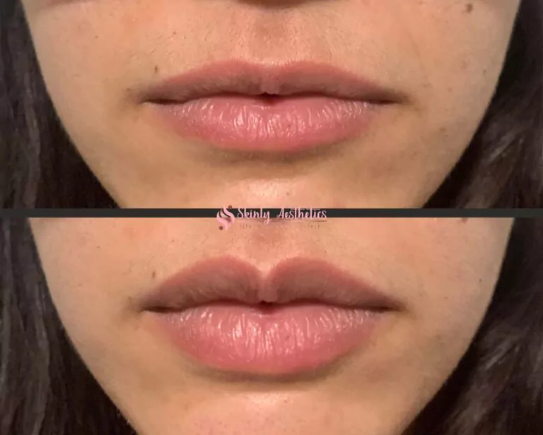 restylane filler lip injection