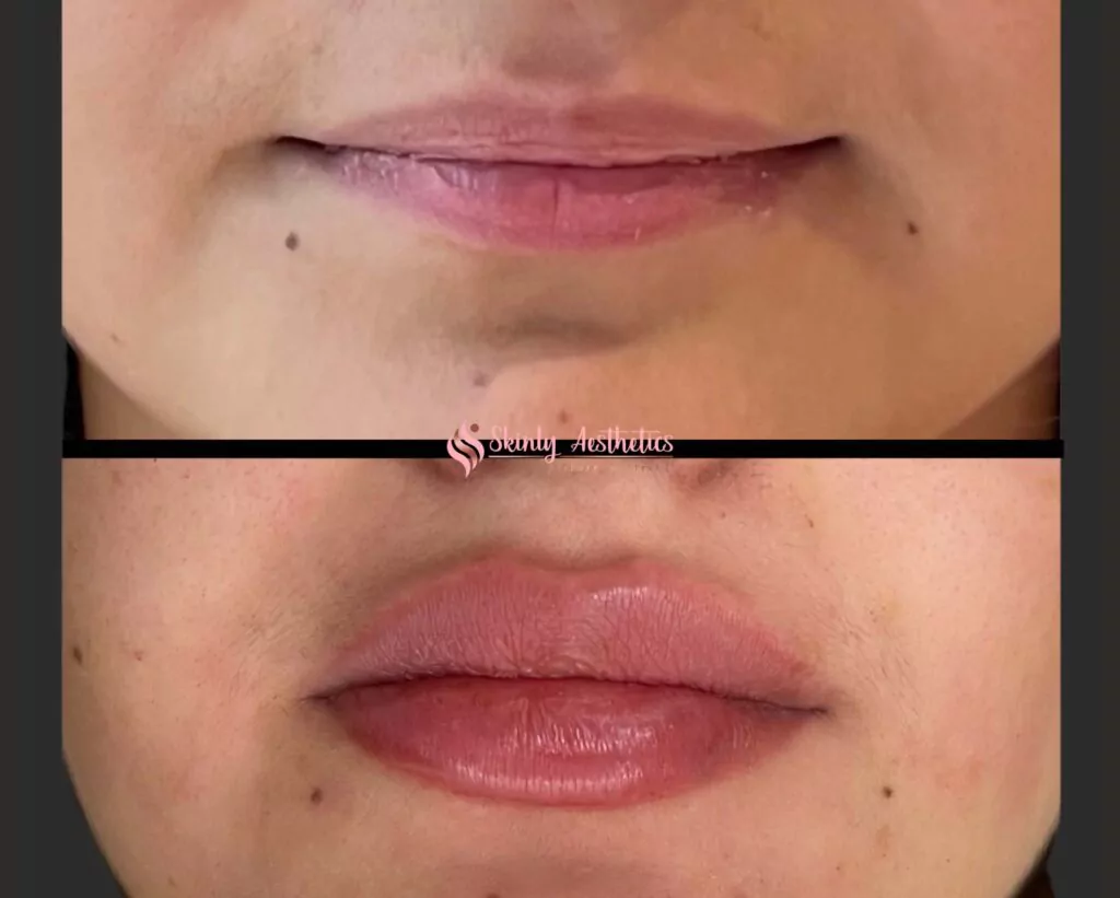 before and after of russian rose lip injection with restylane filler