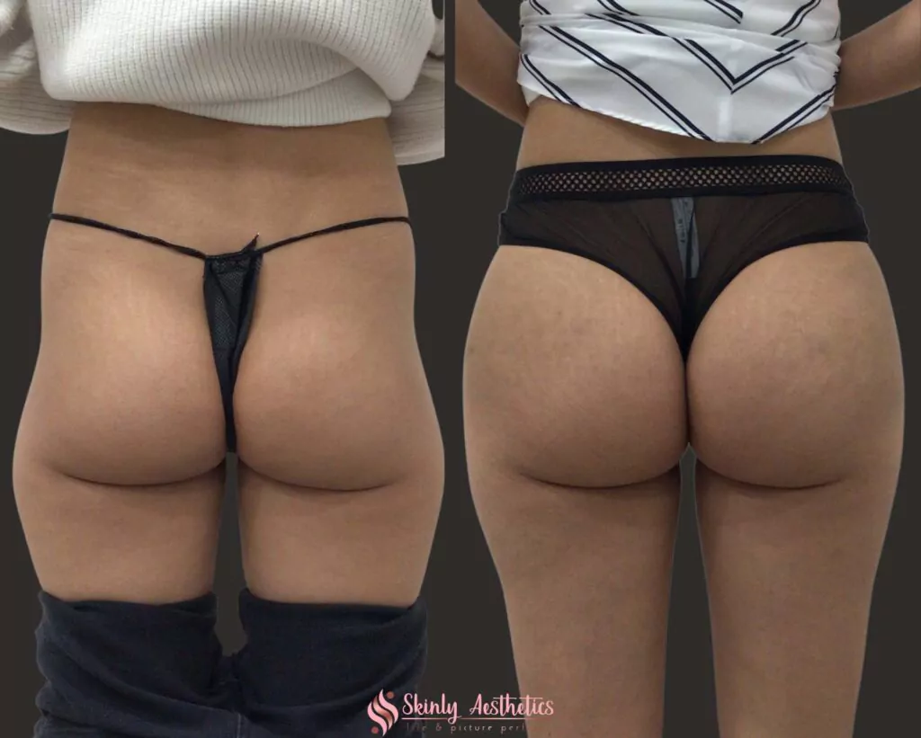 sculptra filler hip dips correction before and after