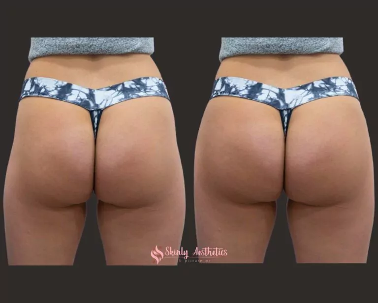 sculptra hip dips before and after 2