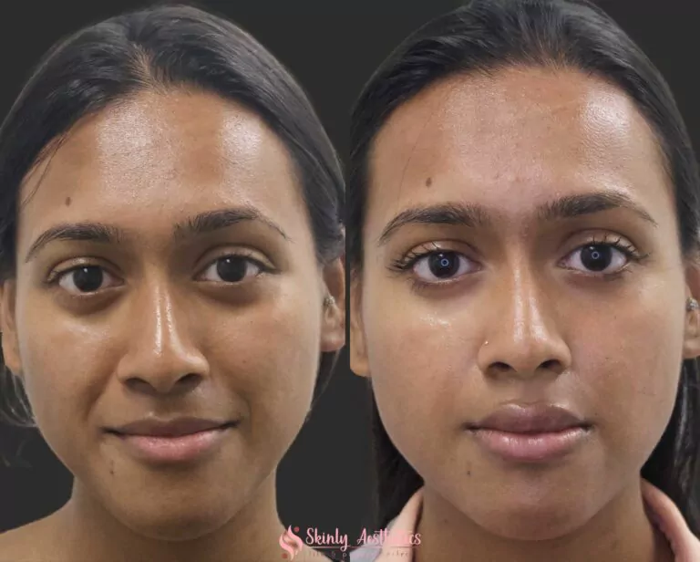 smile lines correction with Juvederm filler