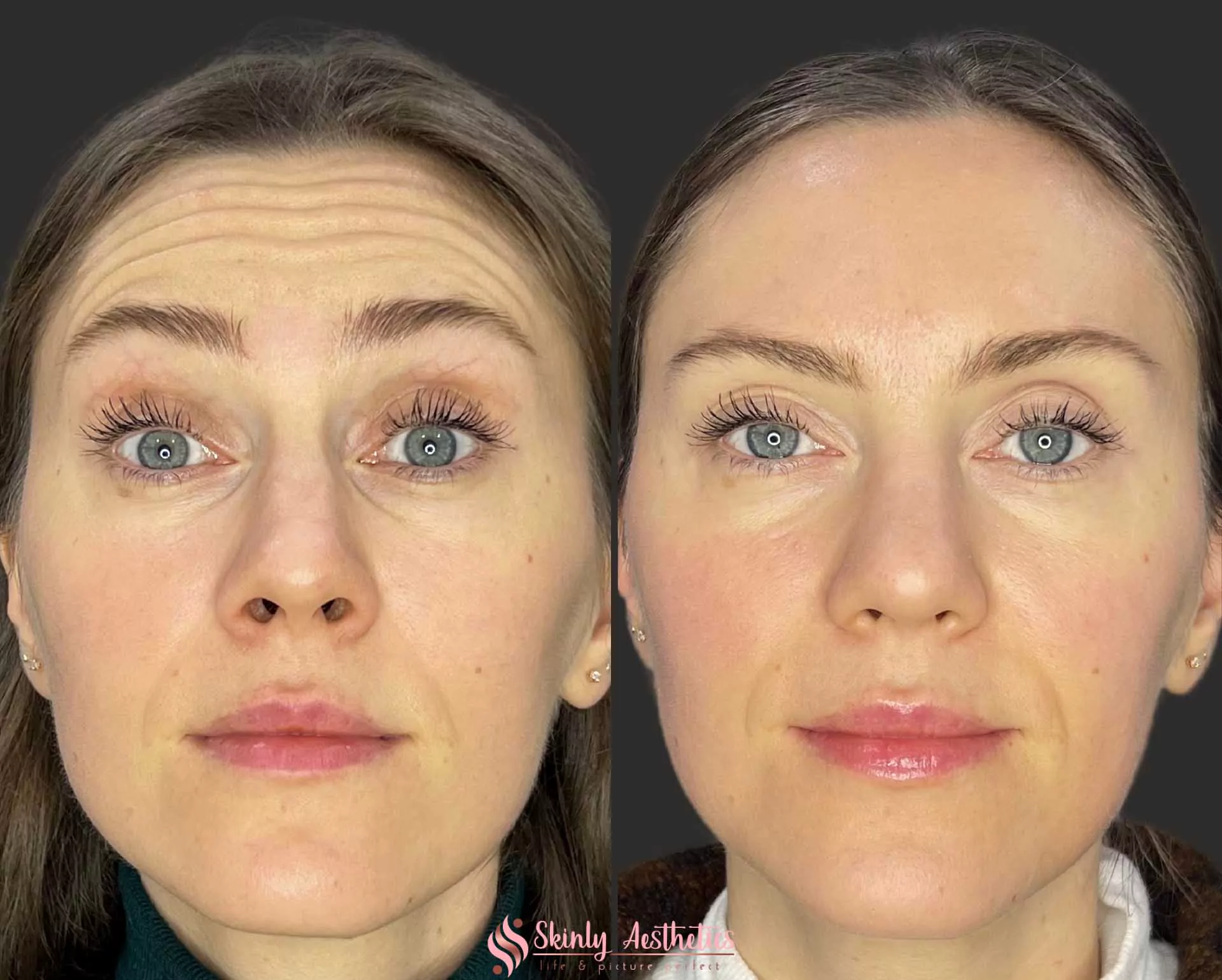smoothing of horizontal forehead lines with 20 units of Botox