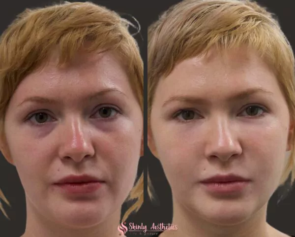 under eye bag treatment with Restylane filler