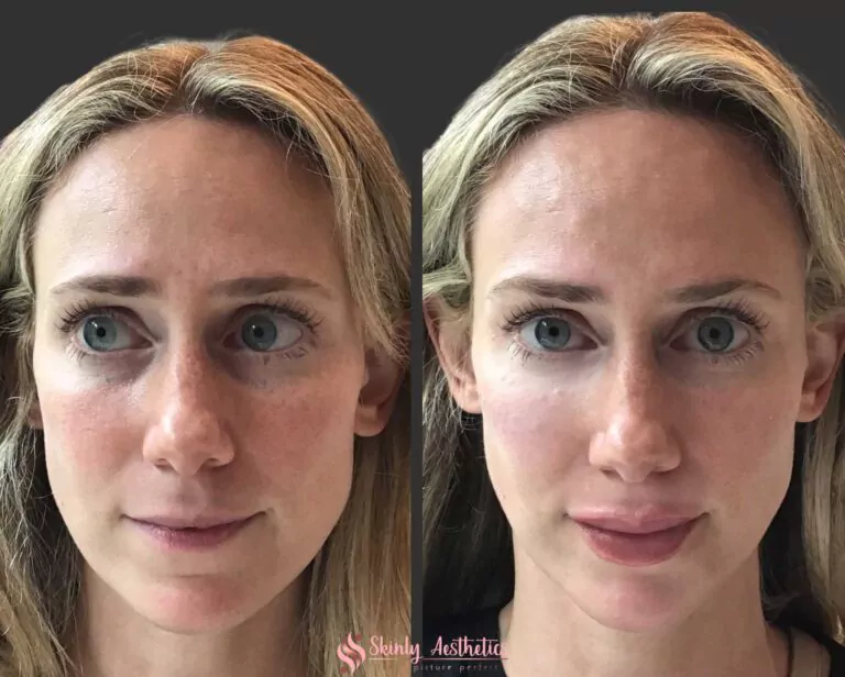 under eye circle treatment with Restylane filler