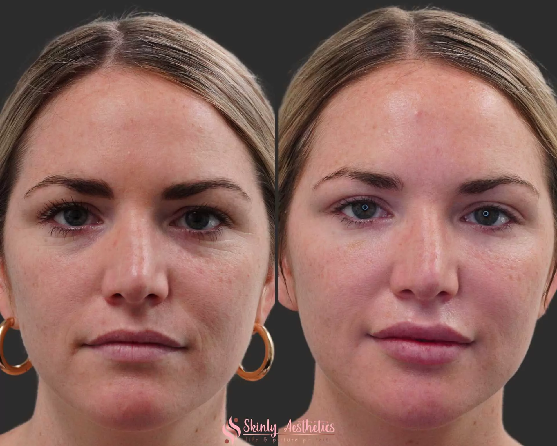 under eye hollow circles treated with Juvederm ultra dermal filler