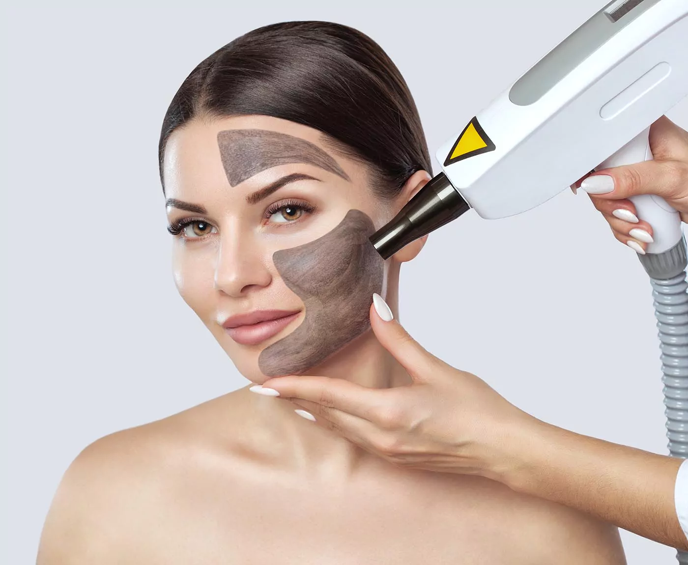 Carbon peel laser facia