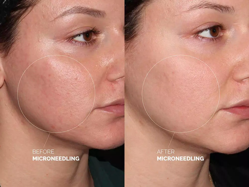 Secret RF radiofrequency fractional microneedling at Skinly Aesthetics Current pic