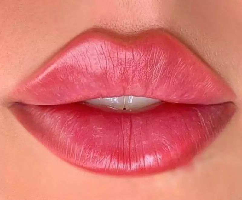 Russian lip filler treatment