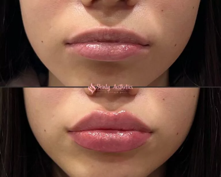 Russian lip technique lip augmentation with Juvederm Ultra