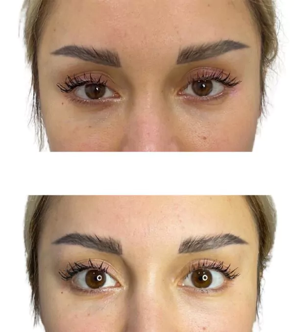 Upneeq eye treatment
